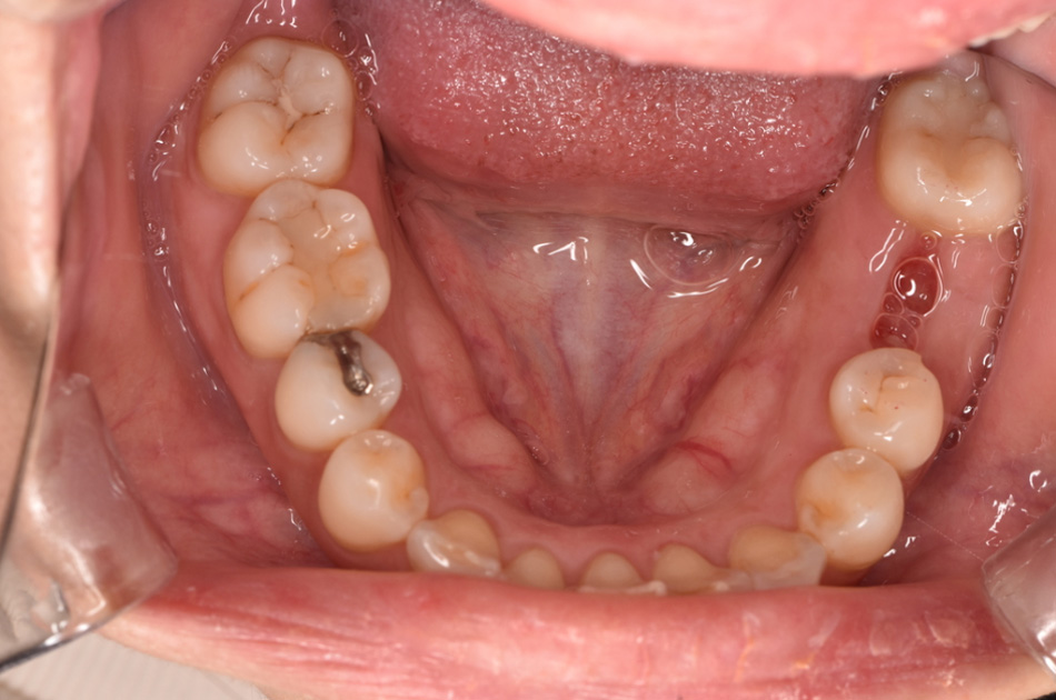 施術前の口内写真01