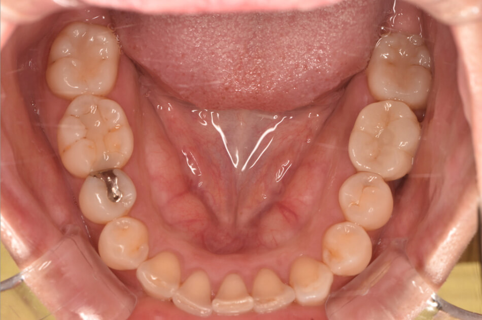 施術前の口内写真02