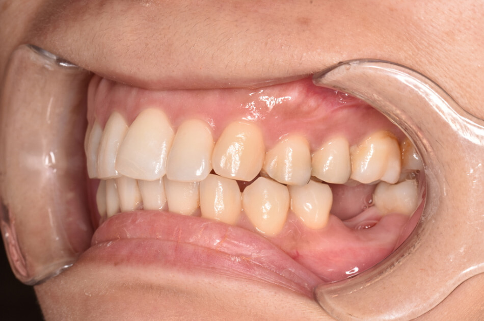 施術前の口内写真03