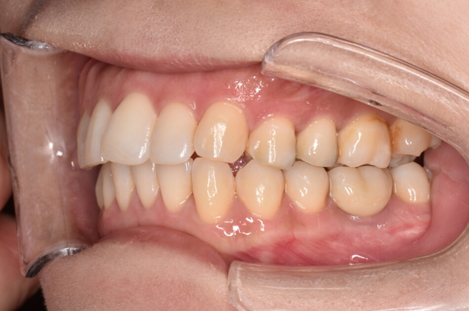 施術前の口内写真04