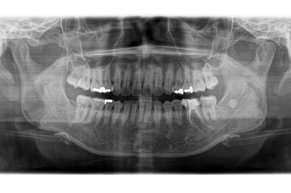 施術前の口内写真05