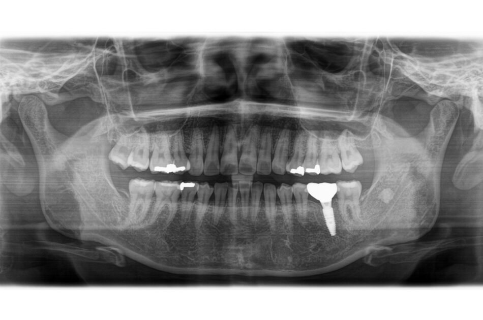 施術前の口内写真06