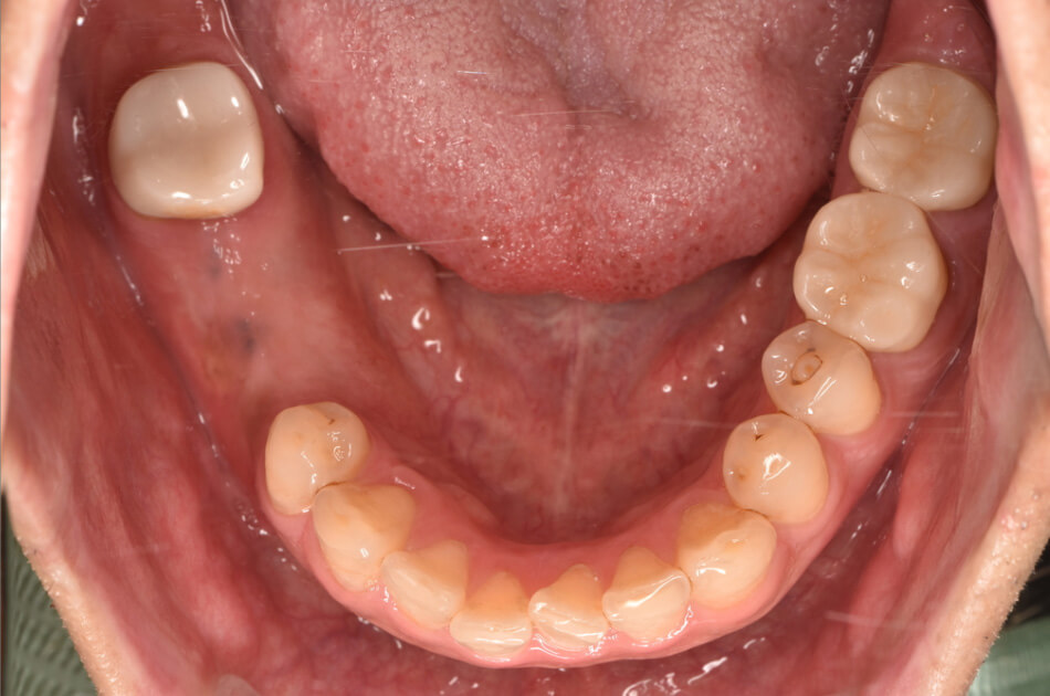 施術前の口内写真01