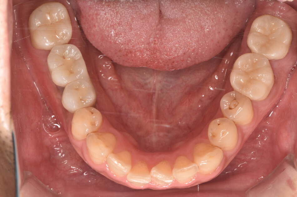 施術前の口内写真02