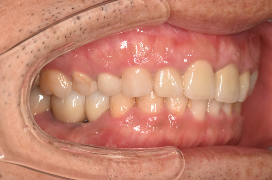施術前の口内写真03