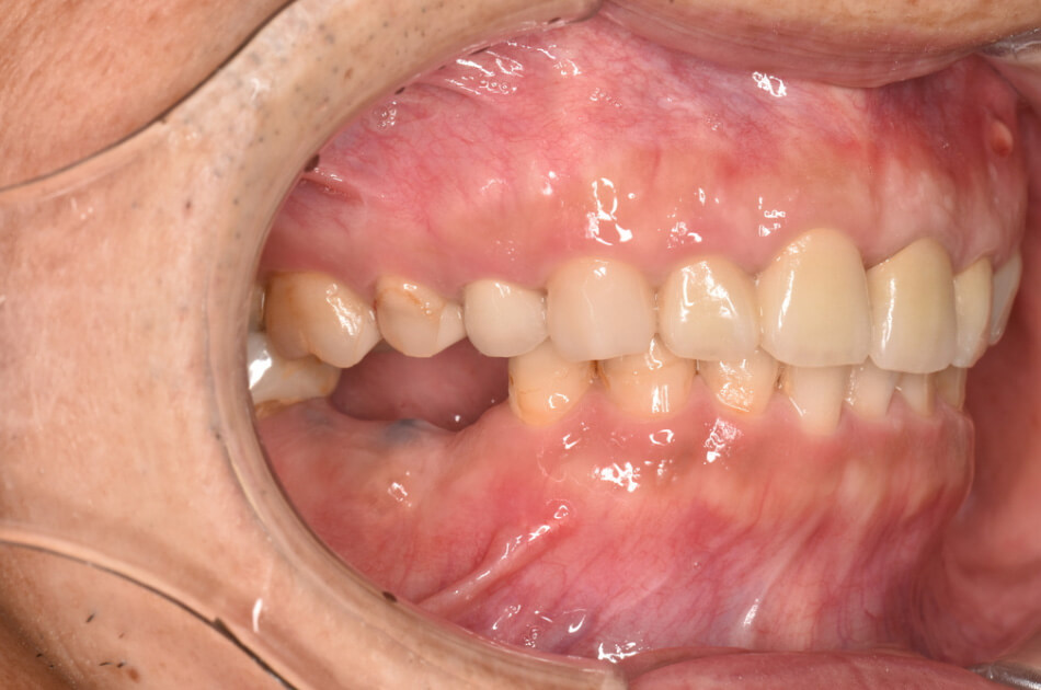 施術前の口内写真04