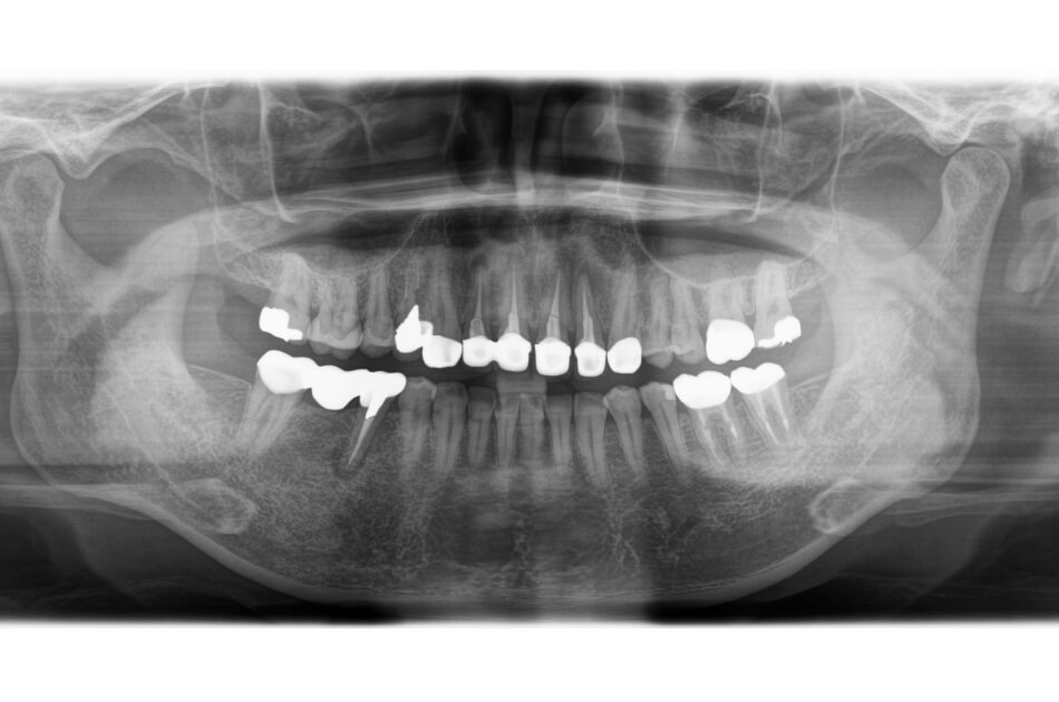 施術前の口内写真05