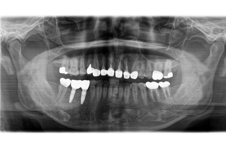 施術前の口内写真06