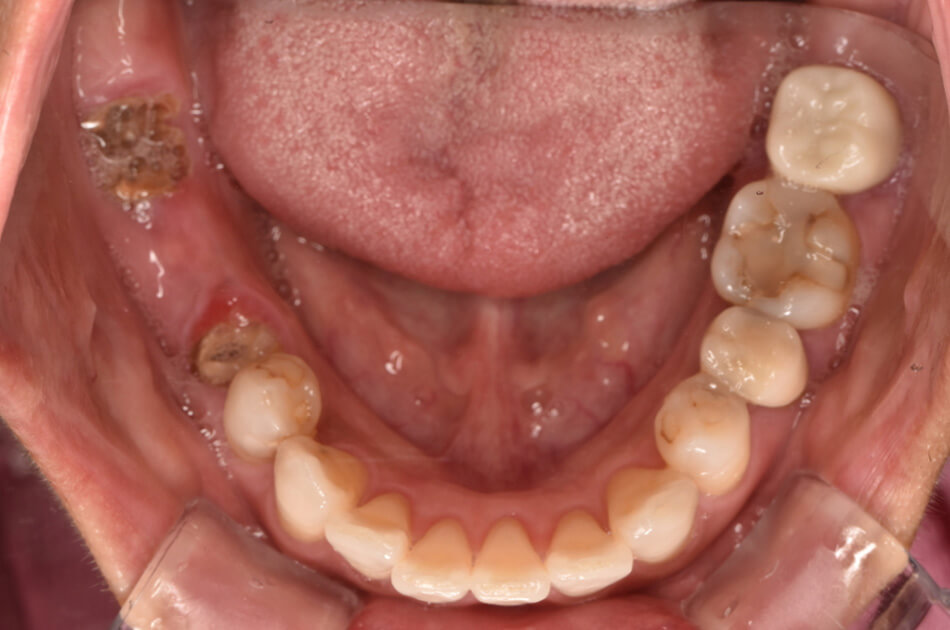 施術前の口内写真01