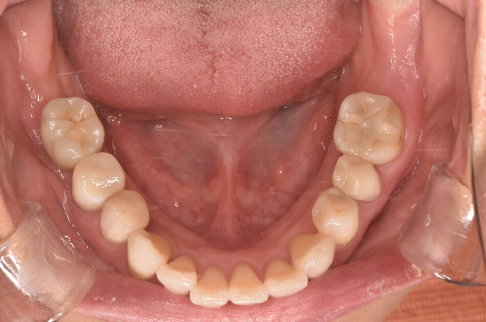 施術前の口内写真02