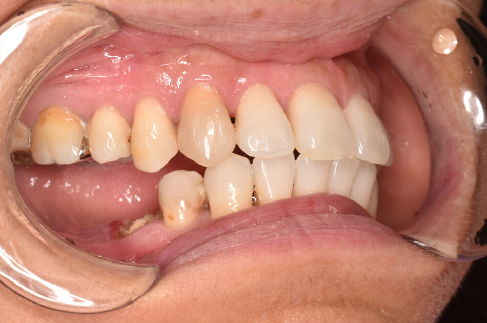 施術前の口内写真03