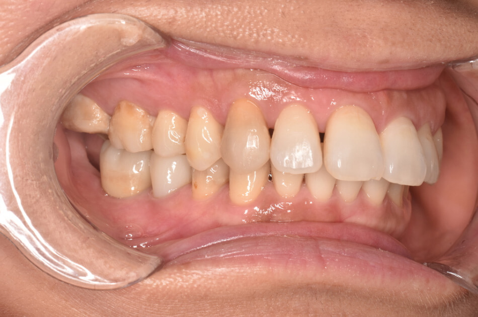施術前の口内写真04