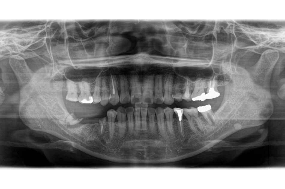 施術前の口内写真05