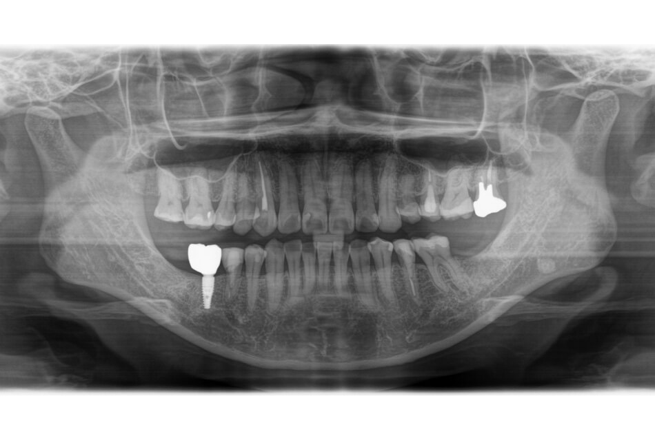 施術前の口内写真06