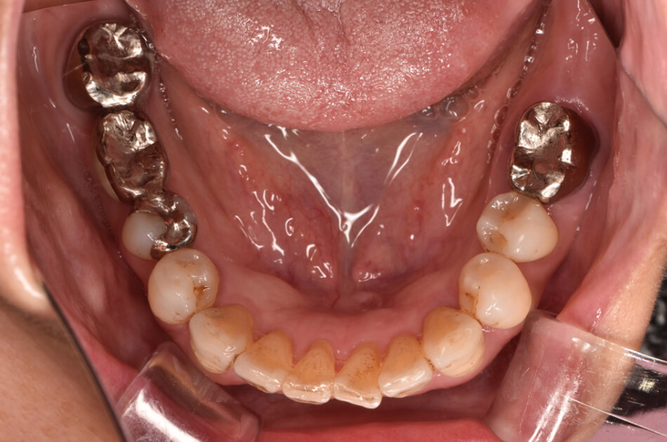 施術前の口内写真01