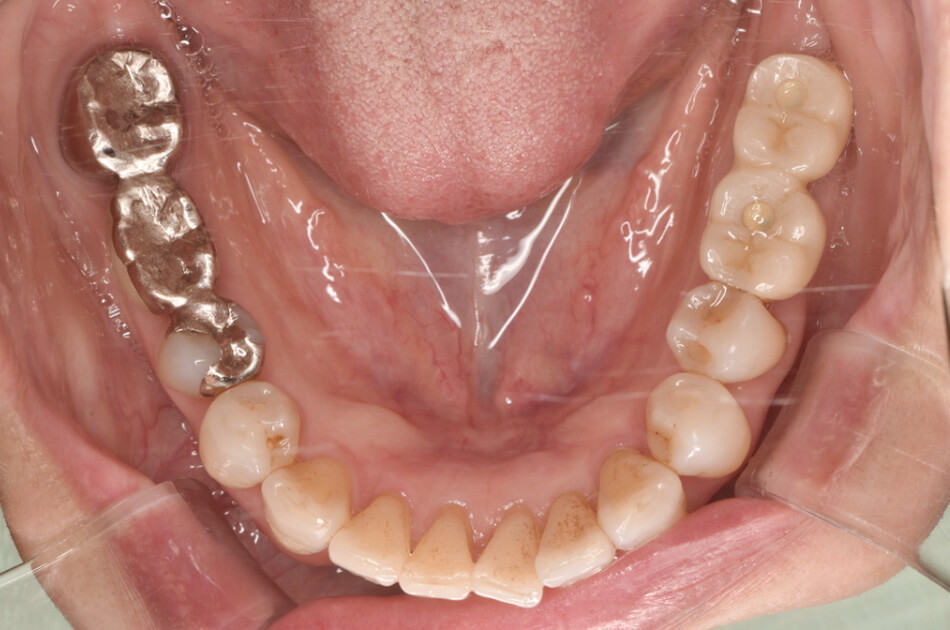 施術前の口内写真02