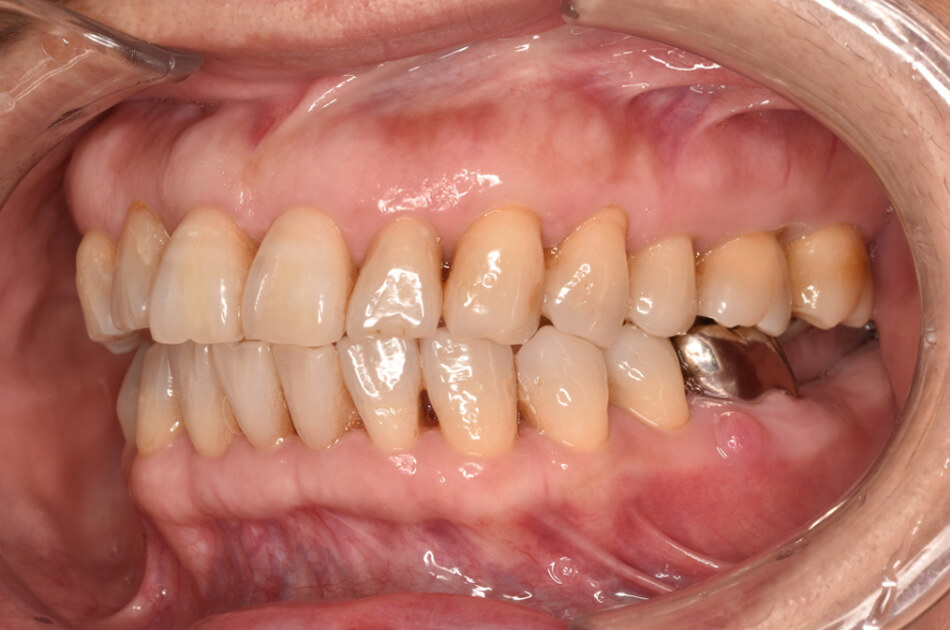 施術前の口内写真03