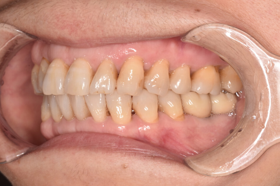 施術前の口内写真04
