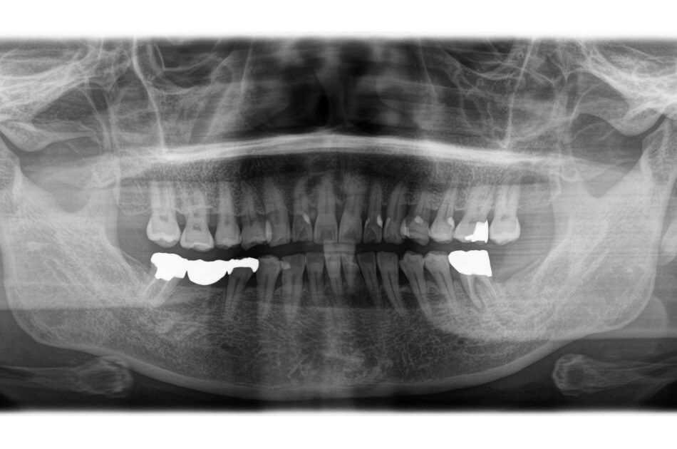 施術前の口内写真05