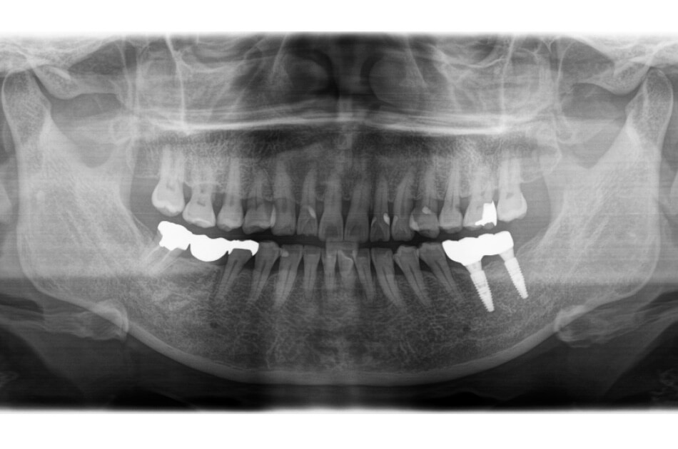 施術前の口内写真06