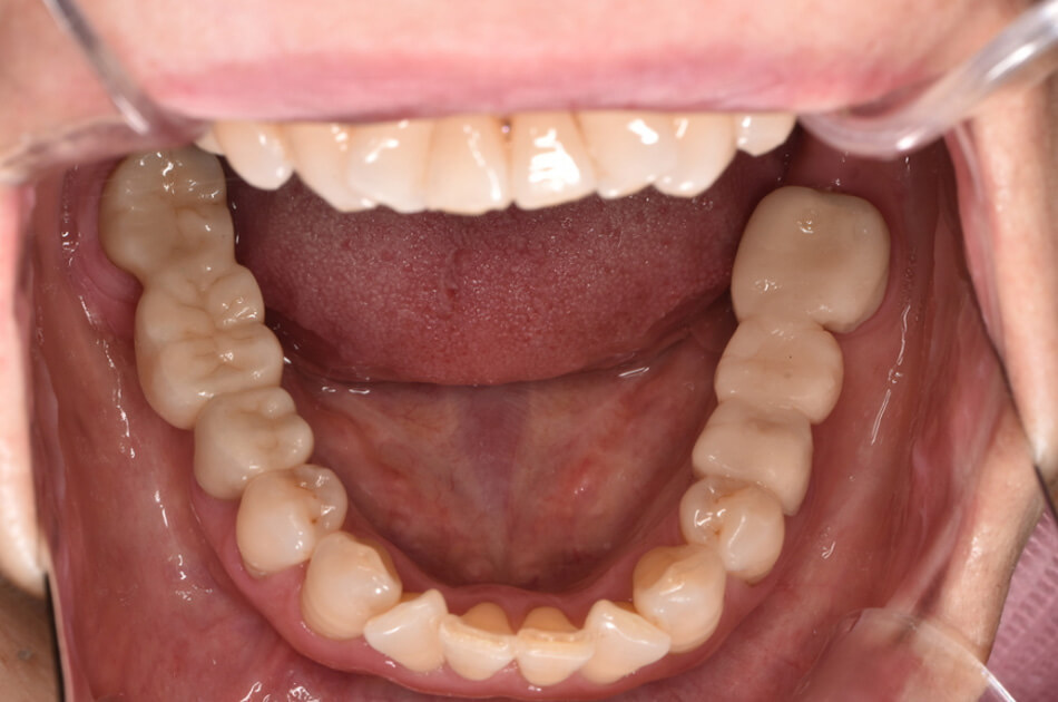 施術前の口内写真01
