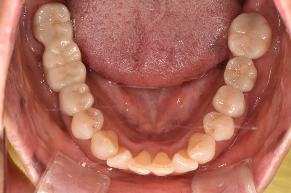 施術前の口内写真02