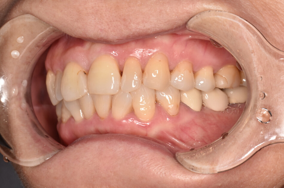 施術前の口内写真03