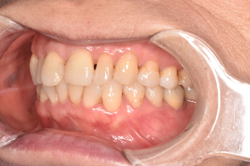 施術前の口内写真04