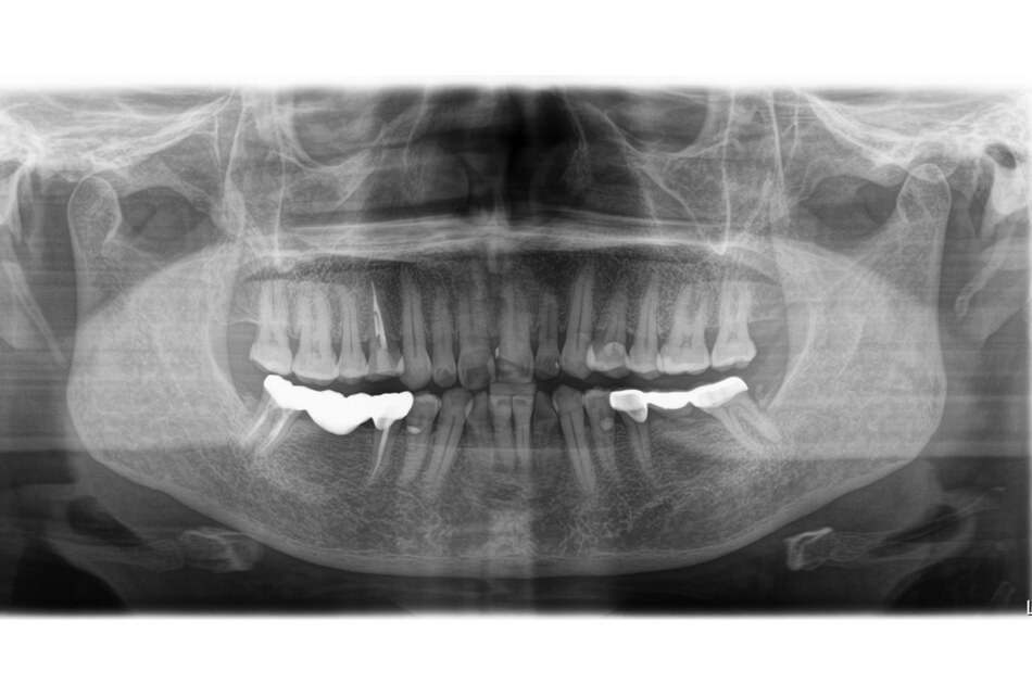 施術前の口内写真05