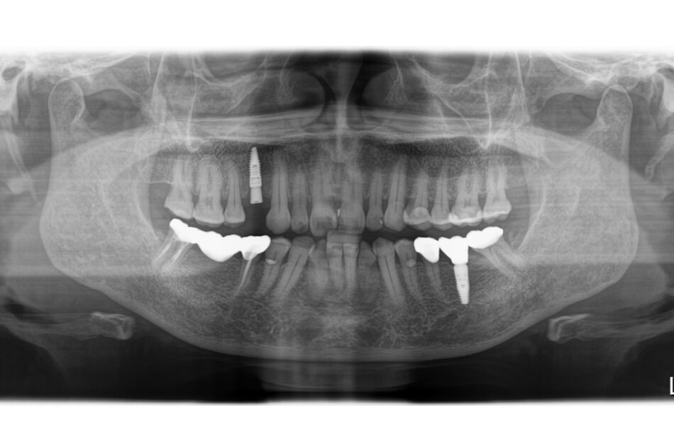 施術前の口内写真06