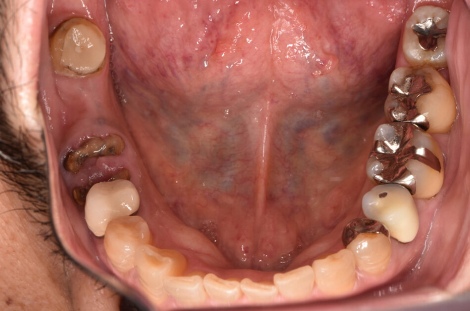 施術前の口内写真01