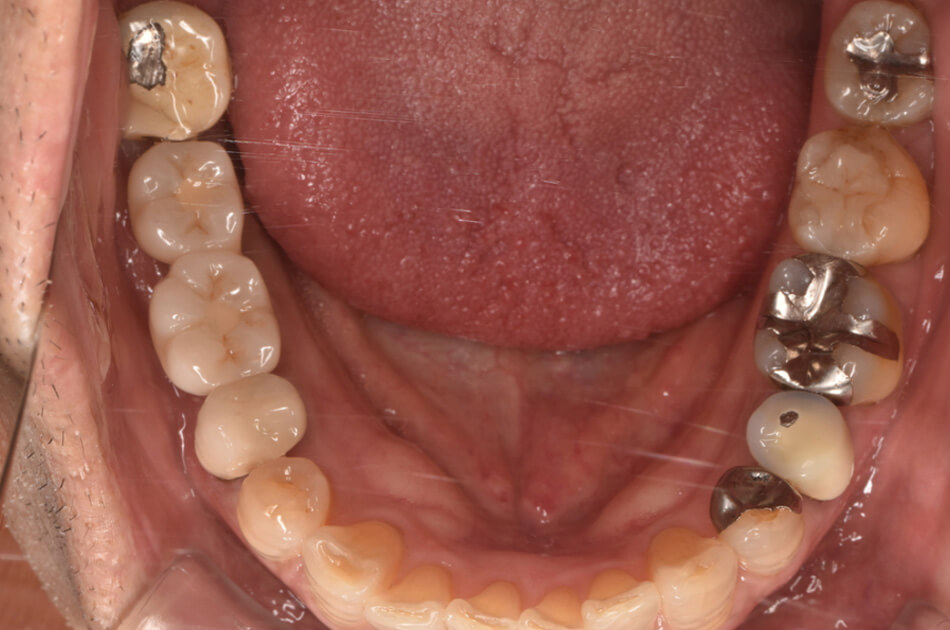 施術前の口内写真02