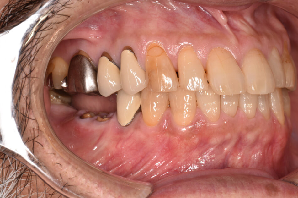 施術前の口内写真03