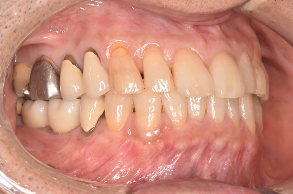 施術前の口内写真04