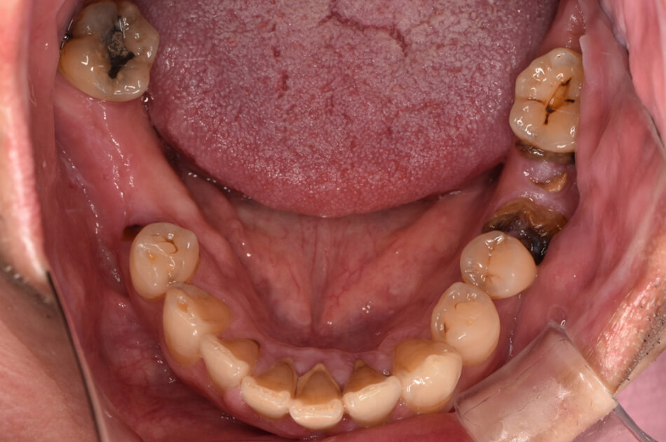 施術前の口内写真01