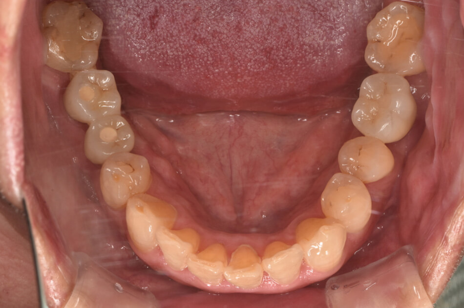 施術前の口内写真02