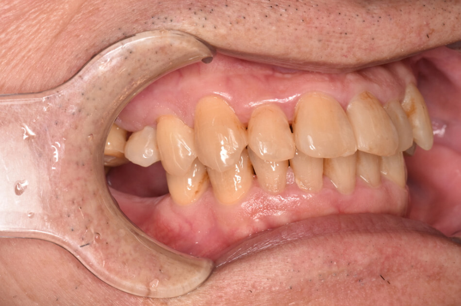 施術前の口内写真03