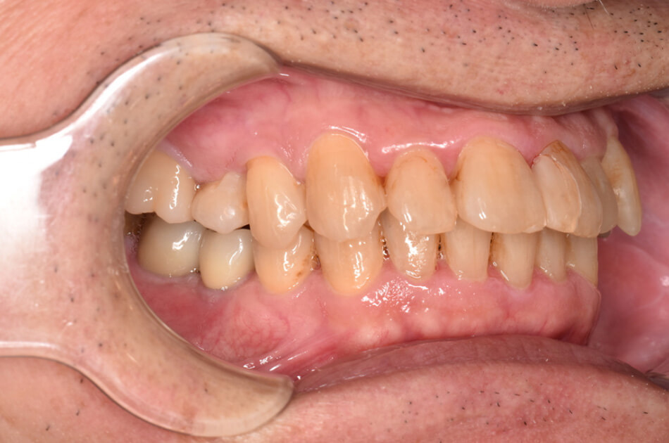 施術前の口内写真04