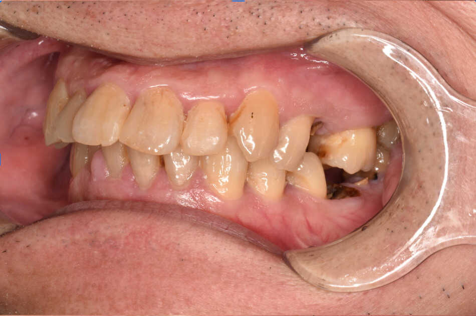 施術前の口内写真05