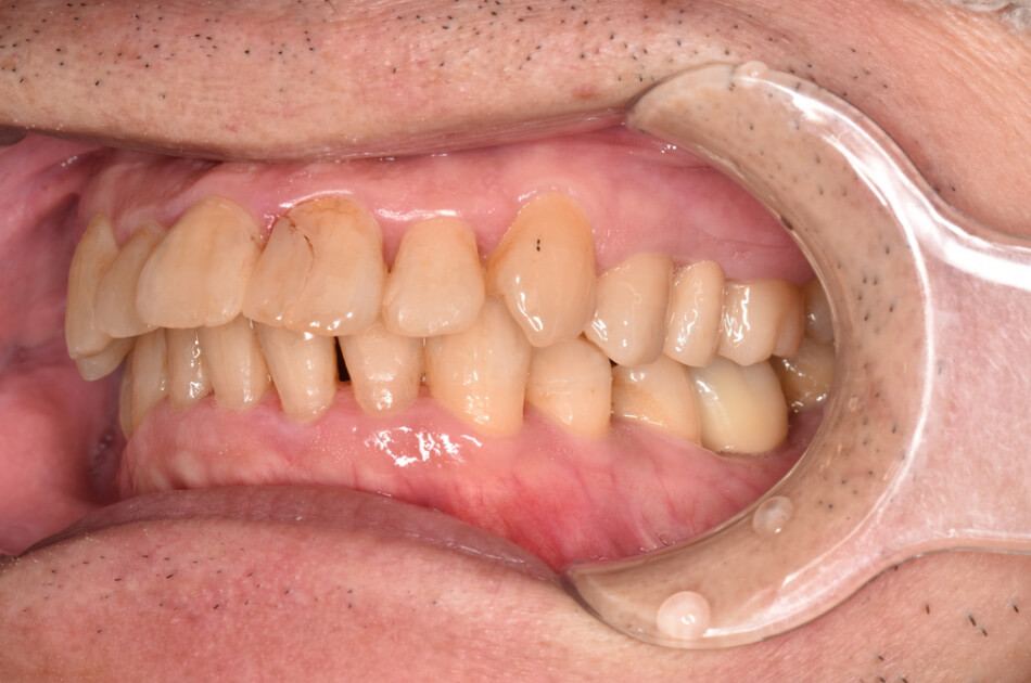 施術前の口内写真06