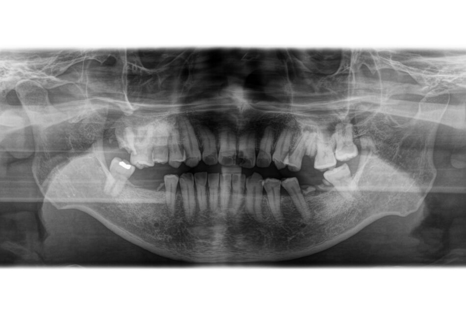 施術前の口内写真04