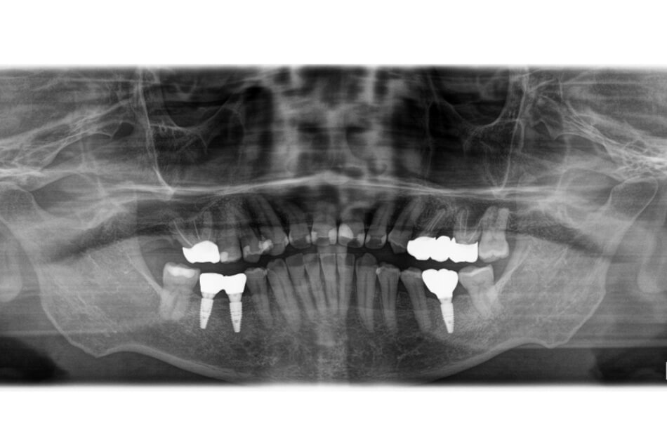 施術前の口内写真08