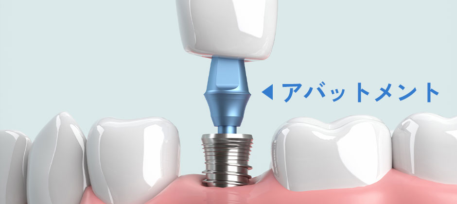 アバットメント交換