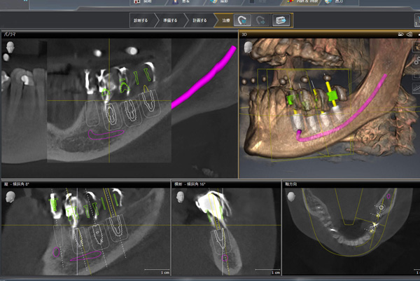 術前の精密計画が治療を決める。