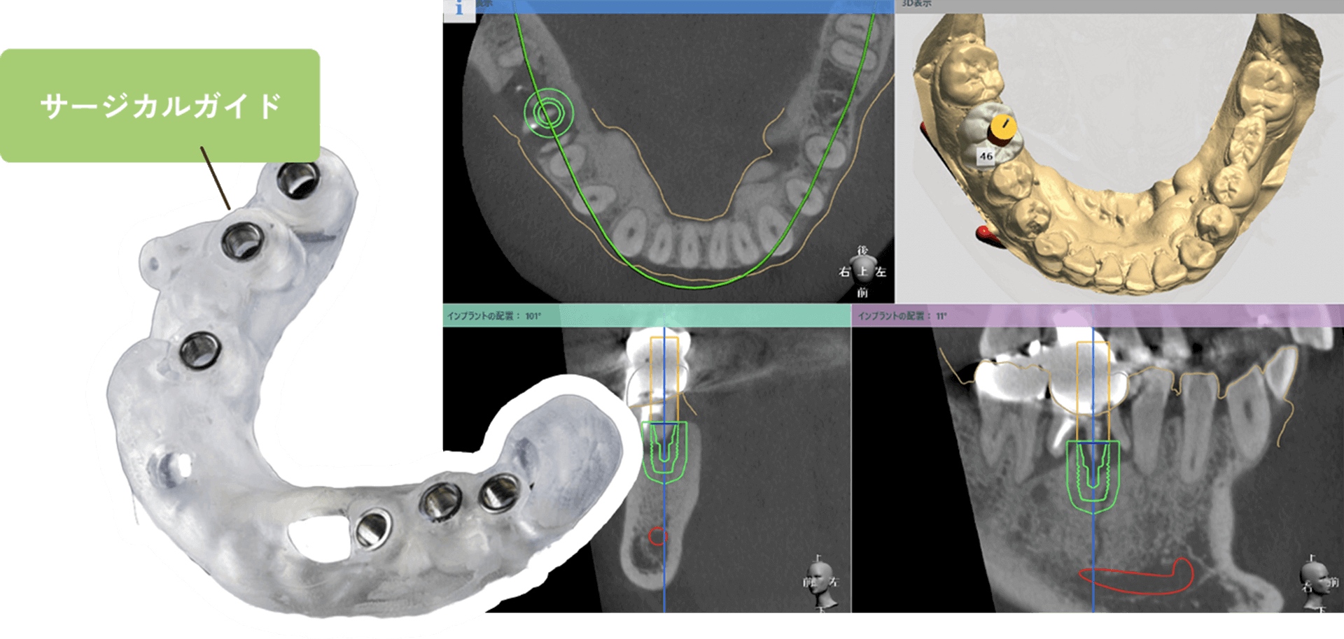 サージカルガイド