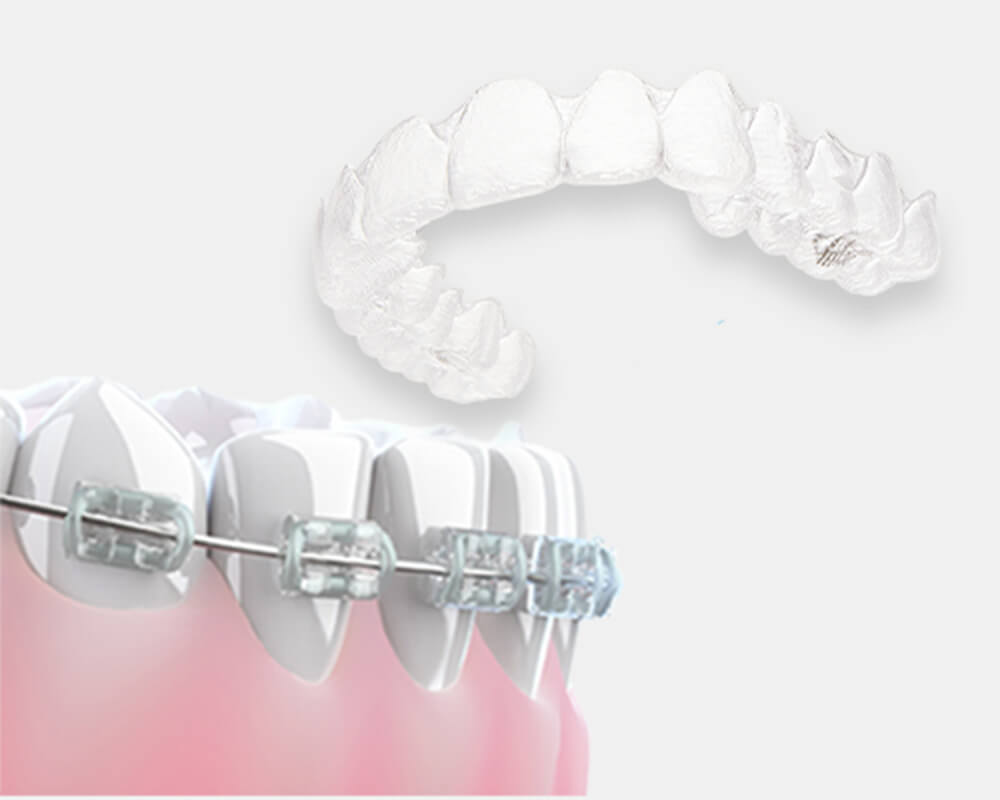 矯正治療中の方の疑問…