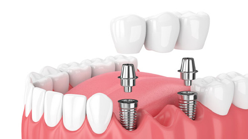 インプラント３本