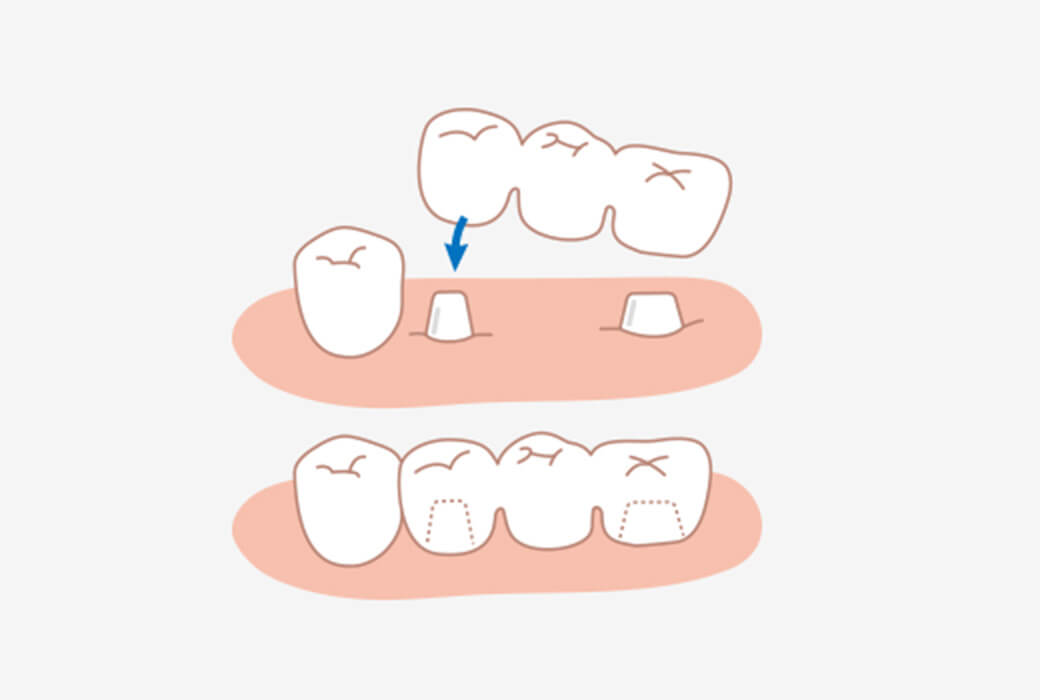 ブリッジ治療を繰り返している方